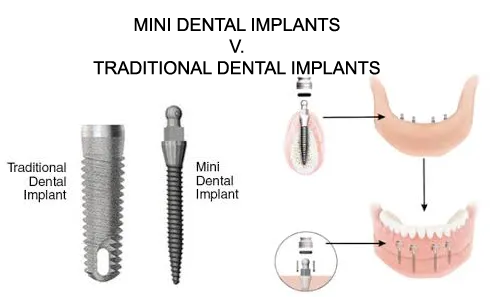 Mini Dental Implants Costs vs. Traditional Dental Implants
